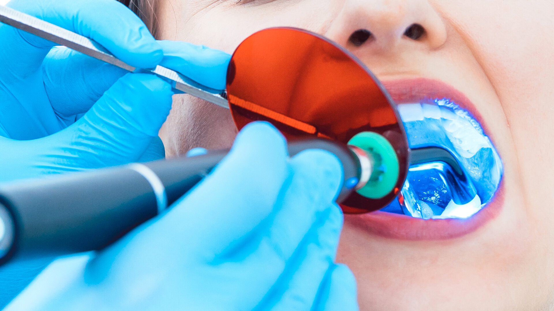 Are Dental Curing Lights Dangerous VeepDental